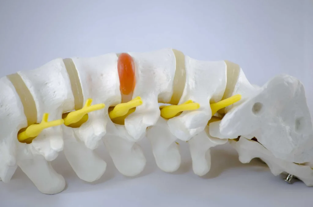 herniated discs