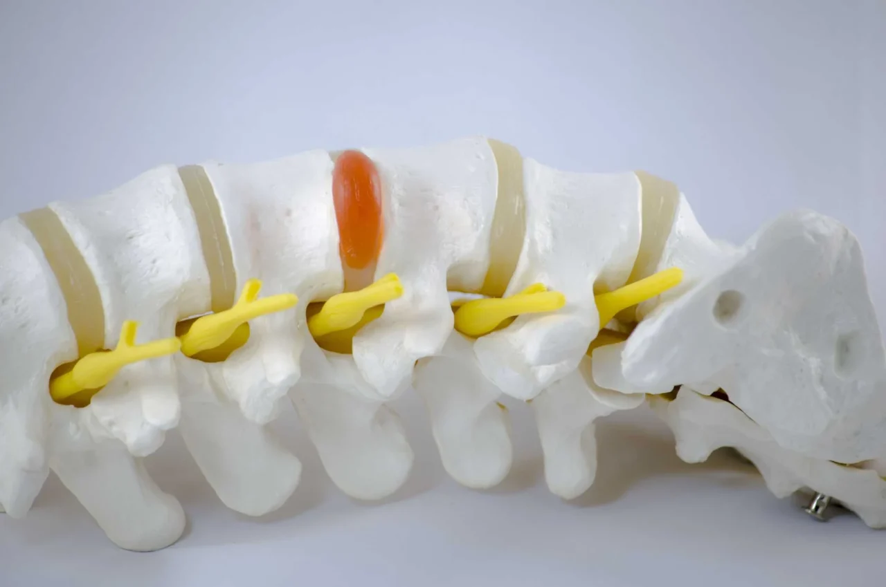 herniated discs